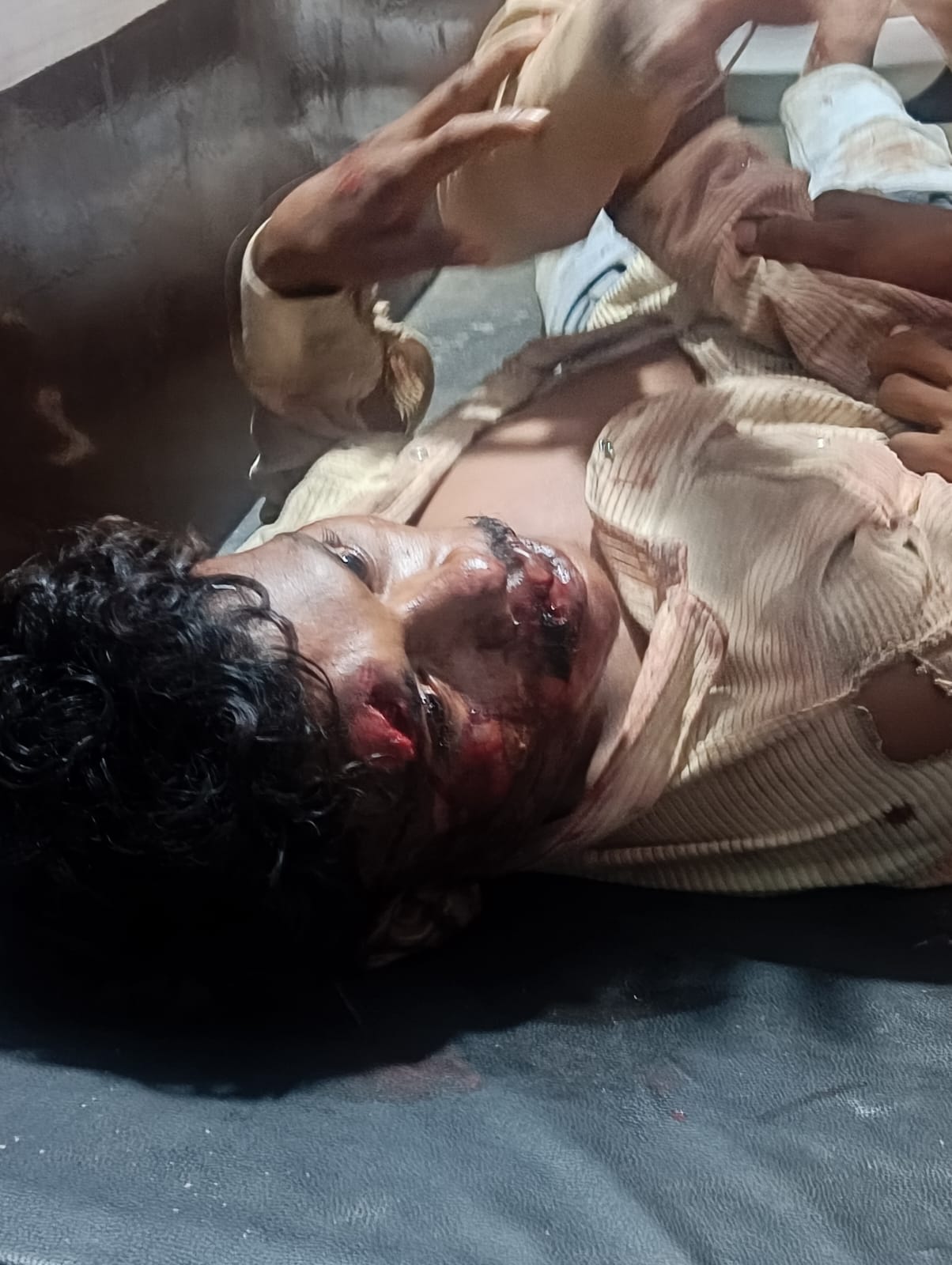 तेज़ रफ्तार या असावधानी बन सकती है हादसे की वजह : ईटार में स्कूटी सवार युवक हुआ गंभीर रूप से घायल, चेहरे पर गहरे ज़ख्म, अस्पताल में इलाज जारी
